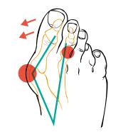 Korektivne trakaste čarape za čukljeve Compressana TAPE SOX Hallux valgus